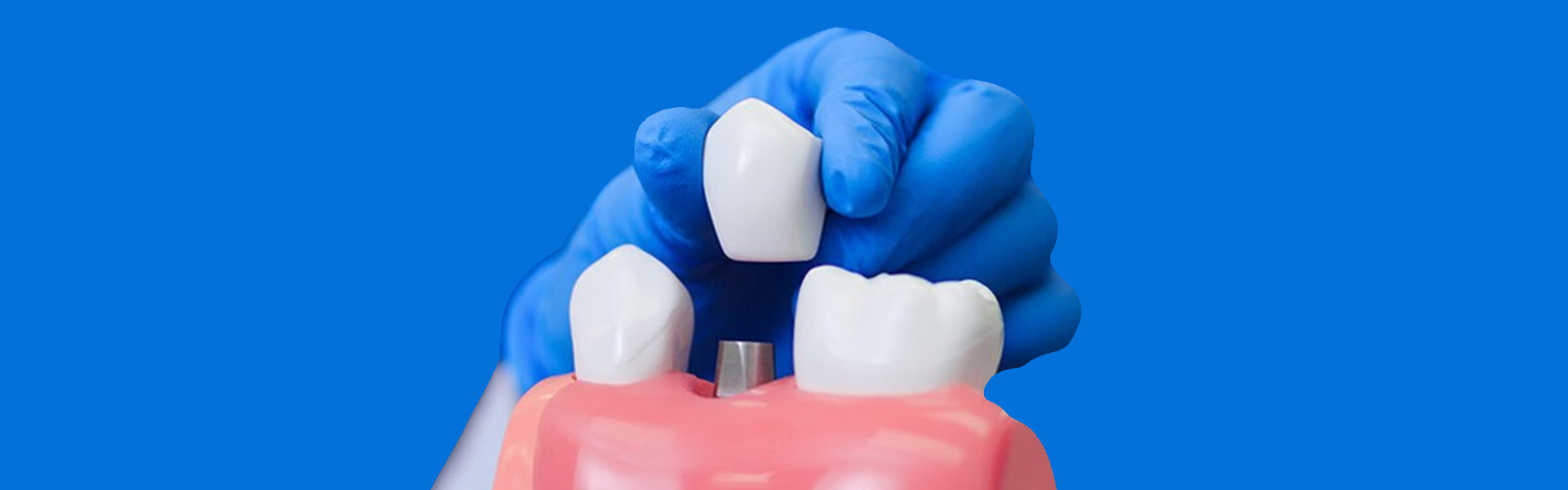 Do Dental Implants Feel Strange Initially? A Comprehensive Guide