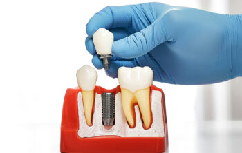 The Benefits of Dental Implants for Long-Term Oral Health