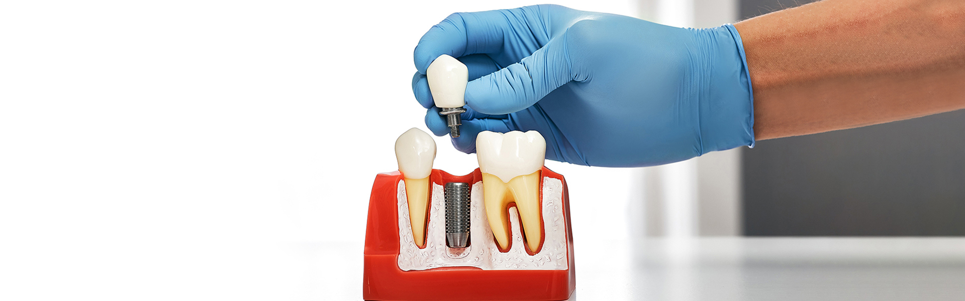 The Benefits of Dental Implants for Long-Term Oral Health