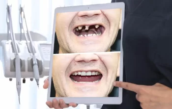 What Procedures Are Included in Full-Mouth Reconstruction?